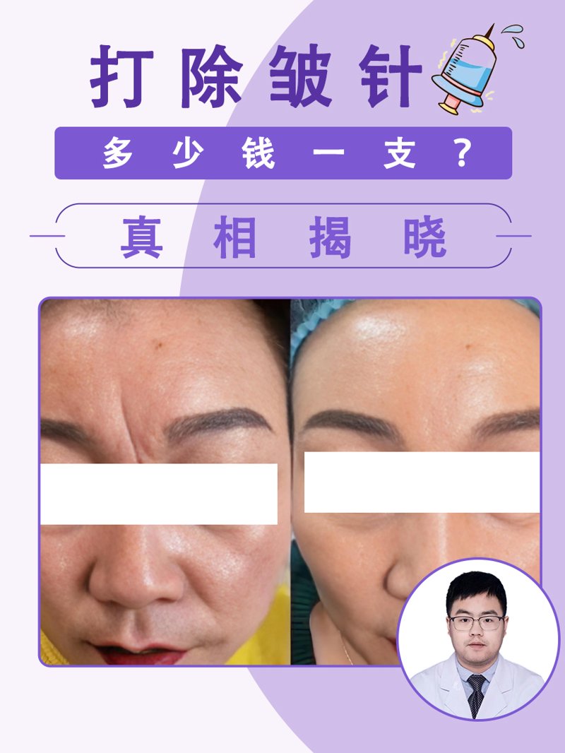 玻尿酸除皱