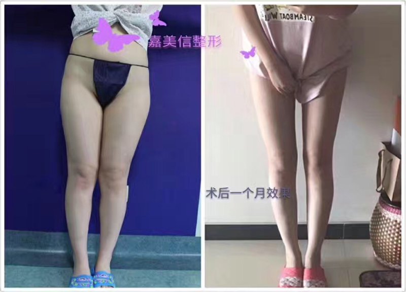 双眼皮手术价格:你了解多少?